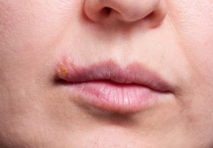 Herpes behandeln