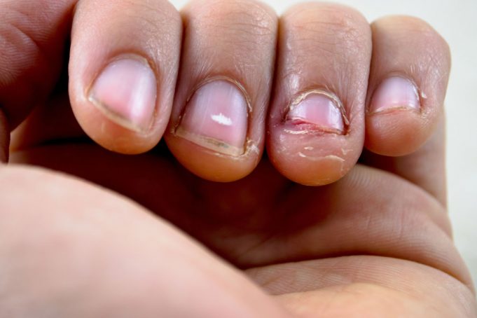 Nagelprobleme Was Hilft Bei Rillen Spliss Und Trockener Nagelhaut 