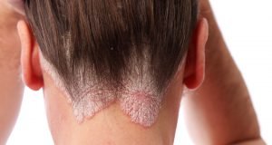 Neurodermitis auf der Kopfhaut