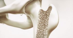 Osteoporose Risiken