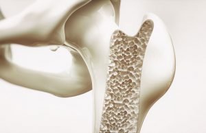Osteoporose Risiken