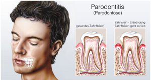 Parodontose
