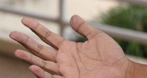 Tipps gegen schwitzige Hände