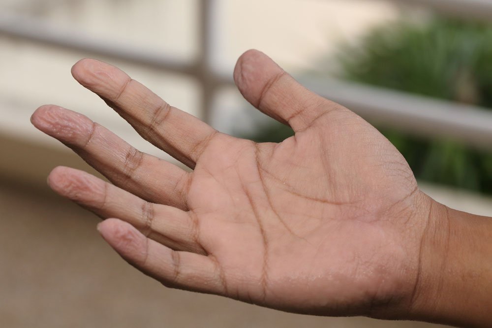 Tipps gegen schwitzige Hände