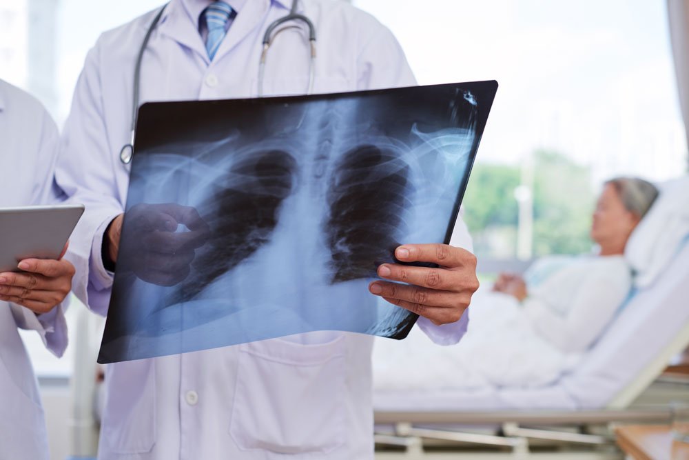 Tuberkulose Röntgen Lunge