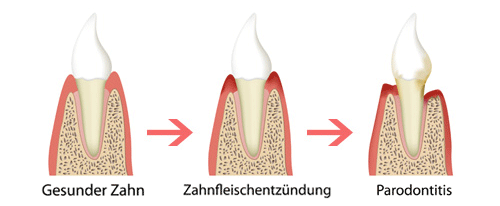Zahnfleischerkrankung Verlauf