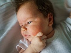 Neurodermitis beim Baby