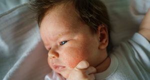 Neurodermitis beim Baby